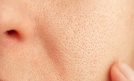 Cách thu nhỏ lỗ chân lông tại nhà đơn giản mà hiệu quả