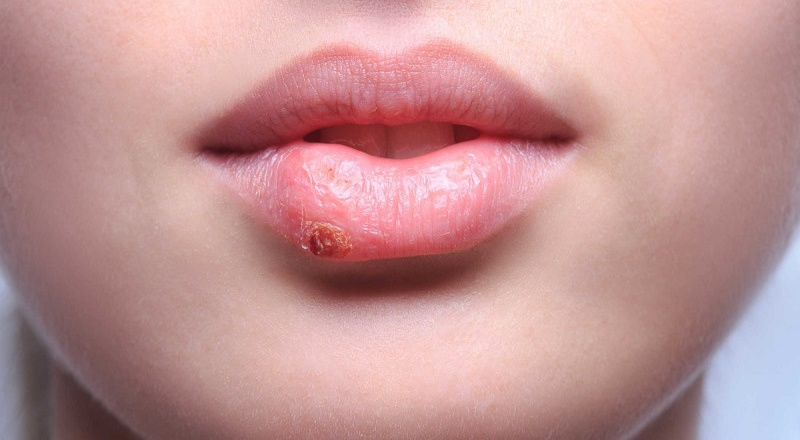 09 lý do bị sưng môi - Đừng bỏ qua kẻo "hối hận" không kịp