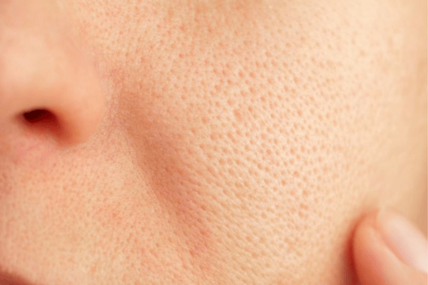 Cách thu nhỏ lỗ chân lông tại nhà đơn giản mà hiệu quả