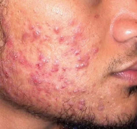 Phương pháp trị mụn hiệu quả do châu Âu, Hàn Quốc công bố được đưa vào nghiên cứu tại Việt Nam