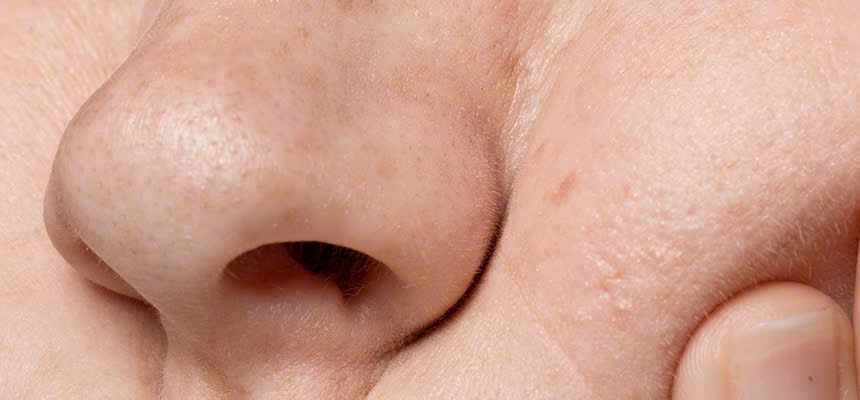Ảnh làn da bị kích ứng và khô, dễ mẫn cảm