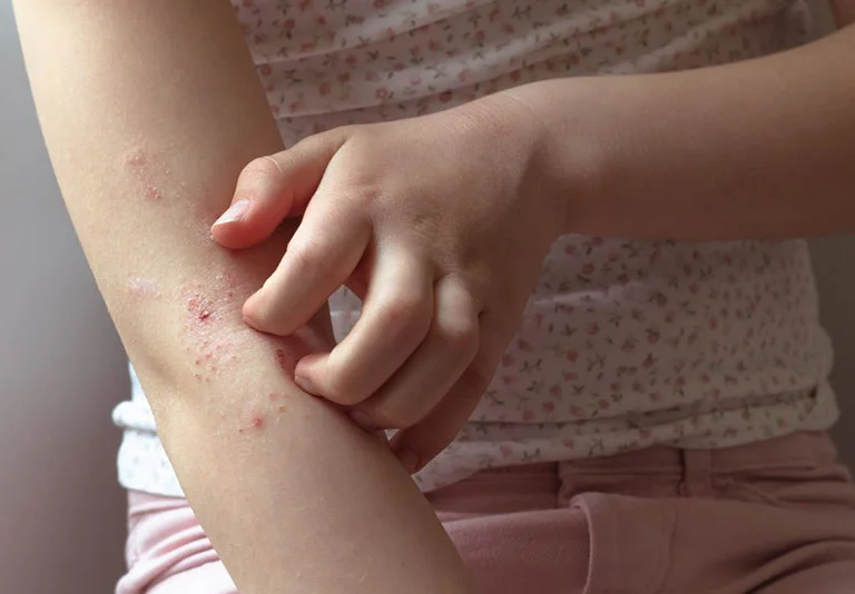 Mùa xuân là thời điểm nhiều người bị ngứa da.