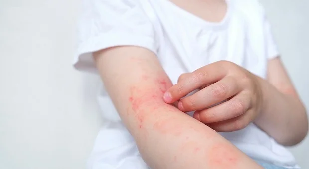 Nhiều người lầm tưởng da dầu không cần dưỡng ẩm khi bị viêm da dị ứng.