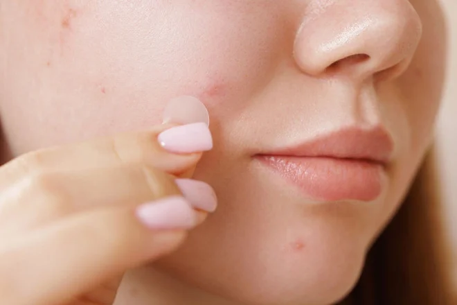 Miếng dán mụn rất tiện lợi, nhưng nếu dùng sai, bạn có thể làm da viêm nặng hơn hoặc khiến vết thương chậm lành.