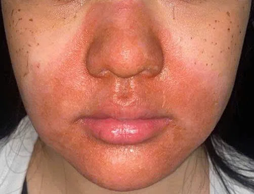 Tổn thương trên da bệnh nhân sau khi peel da tại cơ sở spa.