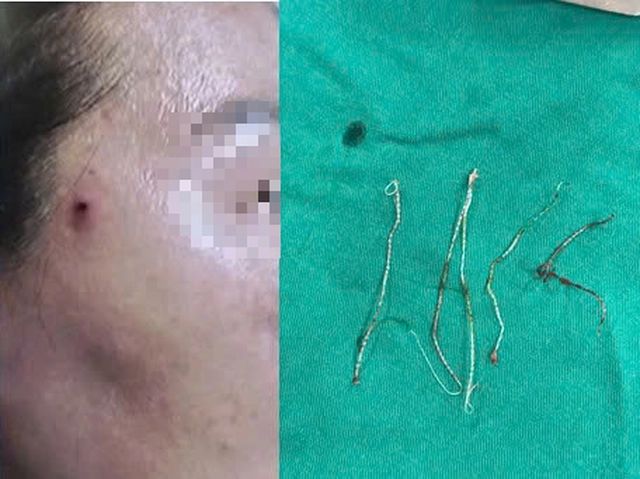 Tổn thương trên má bệnh nhân khi vào viện (trái) và dị vật được loại bỏ (phải).