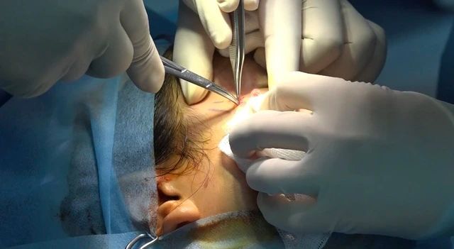 Một trường hợp bệnh nhân bị biến chứng áp xe mặt sau căng chỉ vùng mặt. Ảnh tư liệu.